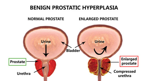 BPH-diagram.jpg
