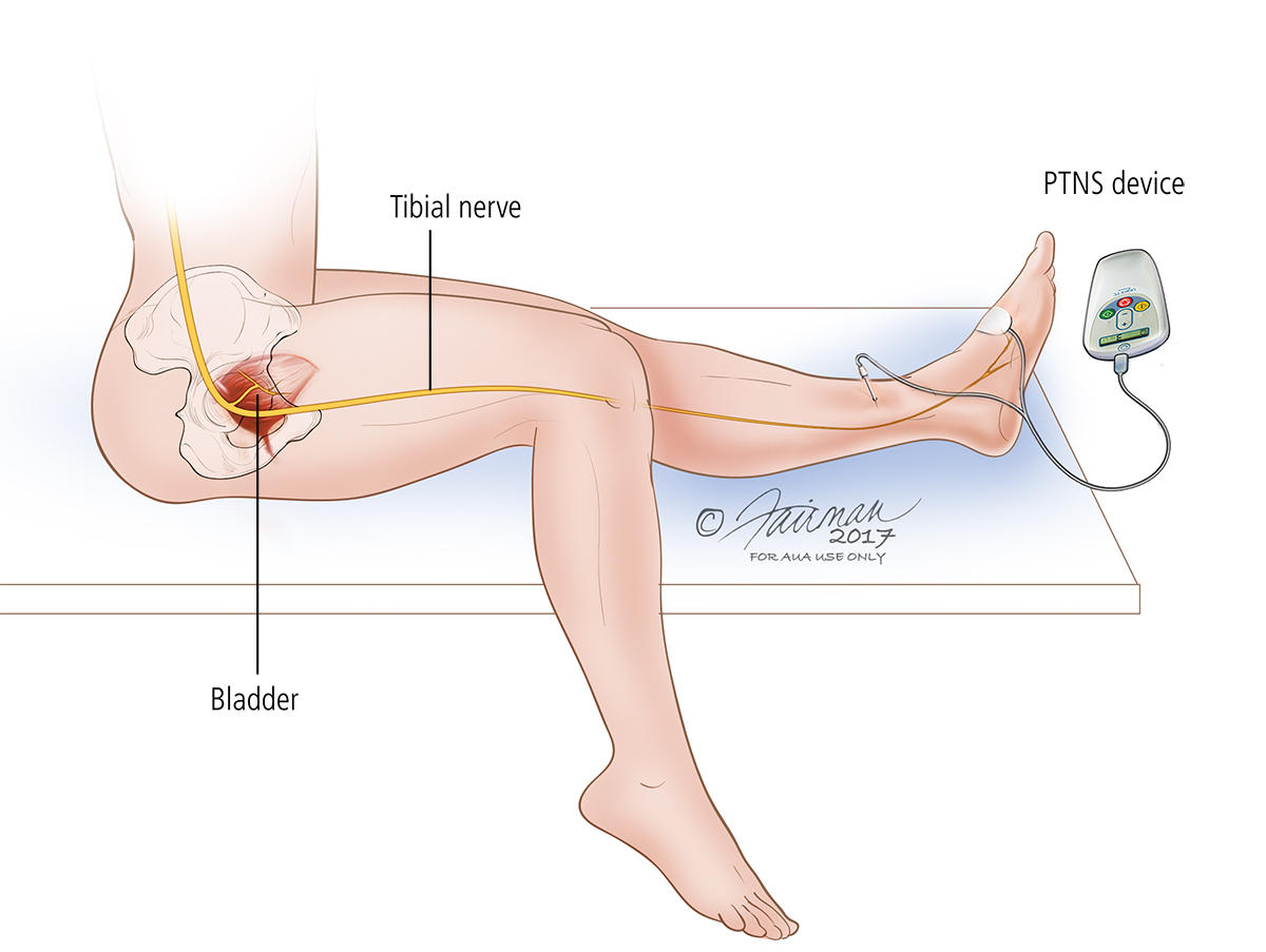 PTNS-Percutaneous-Tibial-Nerve-Stimulation.jpg