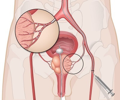 Exciting News! UroPartners Now Offers Prostate Artery Embolization (PAE)